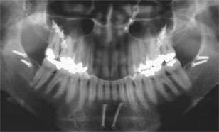 панорамный снимок челюстей (ортопантомограф)