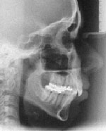 телерентгенограмма ТРГ - снимок черепа в боковой проекции